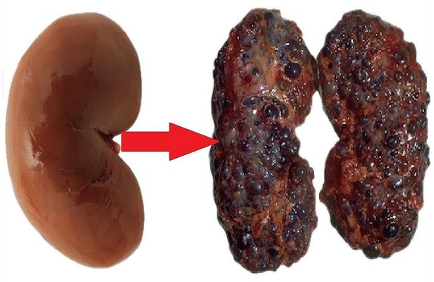 Böbreklere Zarar Veren 10 Tehlikeli Alışkanlık – Çoğu Kişi Farkında Değil.