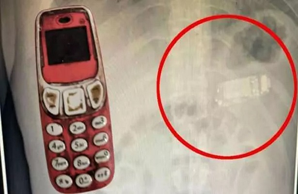 Kosova’da midesinden Nokia 3310 çıktı!