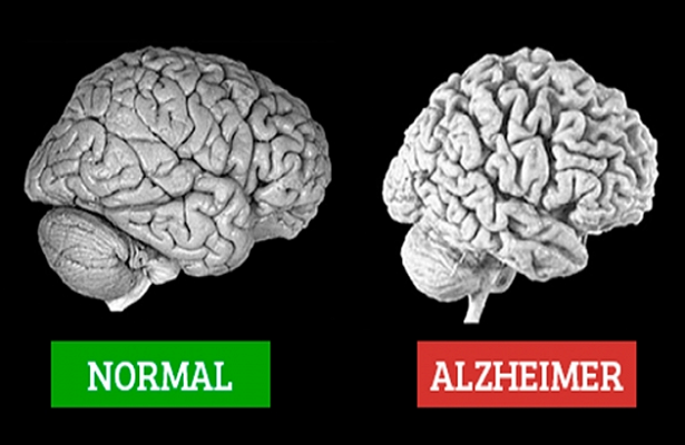 Alzheimer Hastalığı Nedir? Belirtileri Nelerdir?