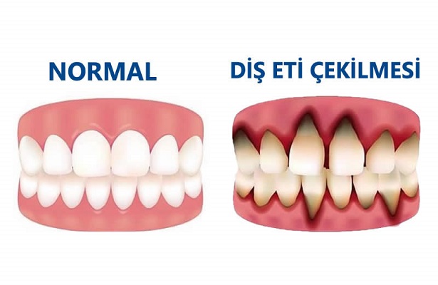 Diş Eti Çekilmesinin Çözümü Var Mıdır?