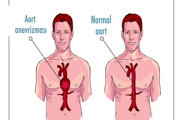 Aort Damarı Yırtılması Nedir ? Tedavisi ve Belirtileri