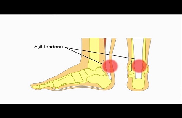 Aşil tendonu nedir? – Prof. Dr. Hakan Özsoy (Ortopedi ve Travmatoloji Uz.)