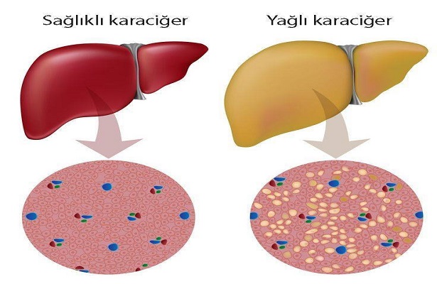 Karaciğer yağlanmasının belirtileri nelerdir ?